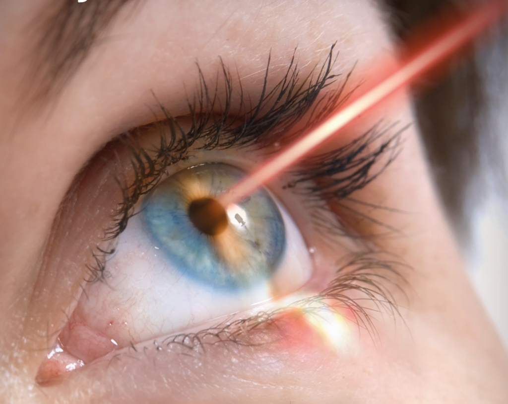 What Is Laser Eye Surgery